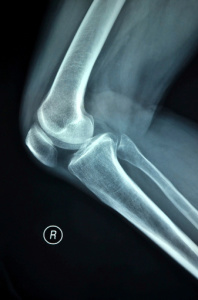 Osteoporosis: The "Thin Bone" Disease: What Women Need to Know | UC Health