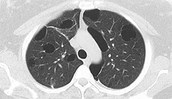 Case Study Update: Novel Use of Intra-Bronchial Valves (IBVs) in Patient with Chronic, Refractory Bronchopleural Fistula Extends the Utility of the Technique