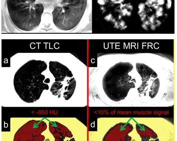 Novel MRI Approaches Provide Risk-free High Resolution Images of Lung Structures