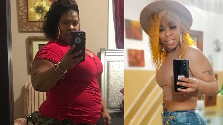 Weight Gain After Gastric Sleeve Surgery