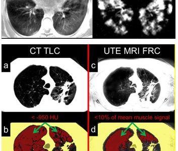 Novel MRI Approaches Provide Risk-free High Resolution Images of Lung Structures