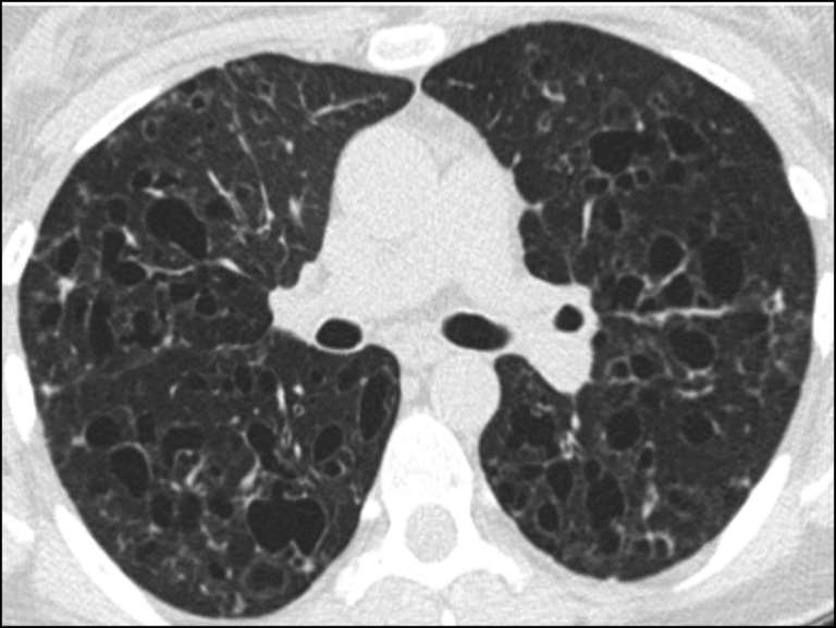 Pulmonary Insights Hrct Is Cost Effective In Screening For Diffuse